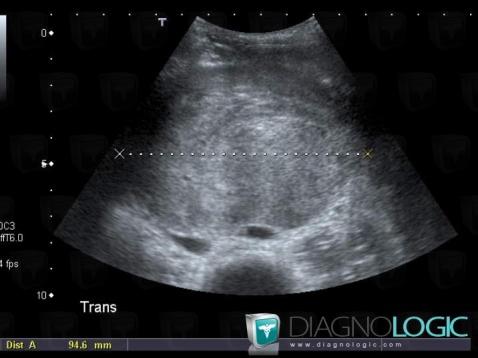 Rhabdomyosarcome, Mésentère / Péritoine, Echographie