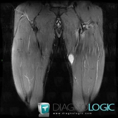 Rhabdomyosarcome, Muscles - Cuisse, Autres parties molles/nerfs - Cuisse, IRM