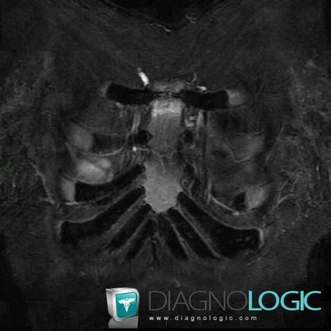 Rheumatoid arthritis, Costosternal / Sternoclavicular joint and Costal cartilage, Sternum, MRI