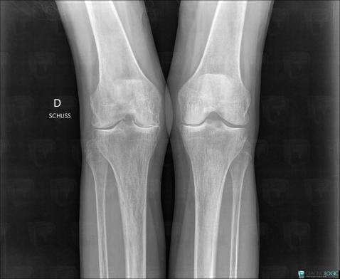 Rheumatoid arthritis, Femorotibial joints - Intercondylar notch, X rays