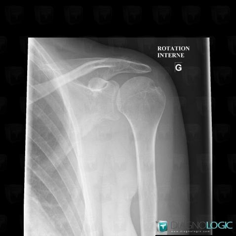 Radiology case : Rheumatoid arthritis (X rays) - Diagnologic