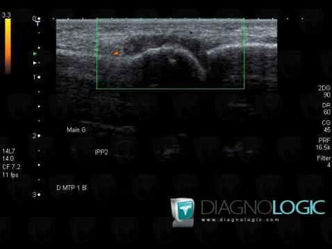 Rheumatoid arthritis, Interphalangeal joint - Hand, US