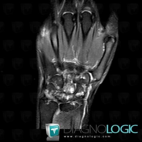 Rheumatoid arthritis, Lunate, Other carpal bones, MRI