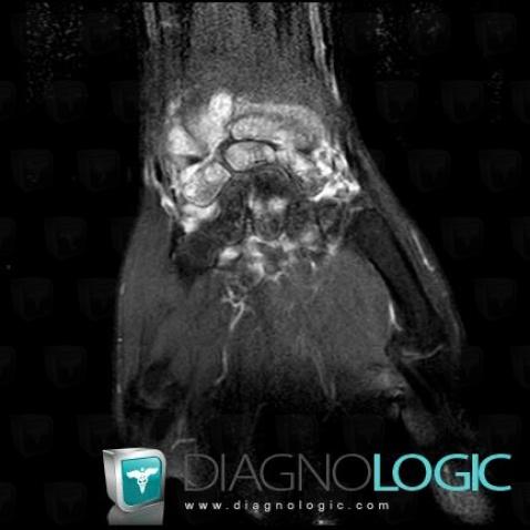 Rheumatoid arthritis, Mediocarpal joint, Radiocarpal joint, MRI