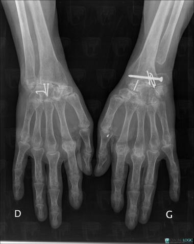 Rheumatoid arthritis, Mediocarpal joint, Radiocarpal joint, X rays