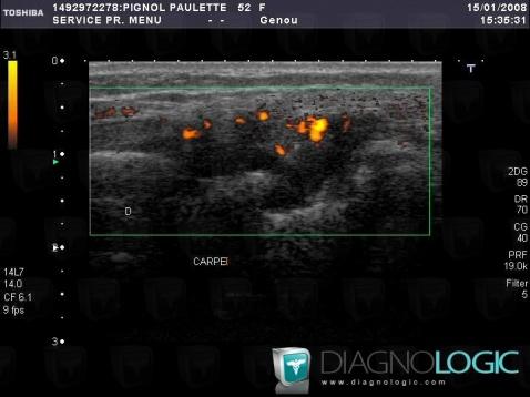 Rheumatoid arthritis, Mediocarpal joint, US