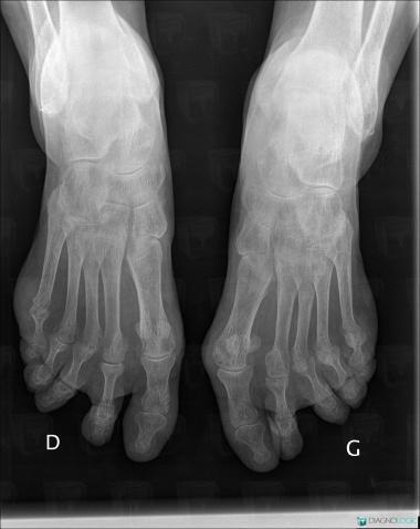 Rheumatoid arthritis, Metacarpophalangeal joints, Interphalangeal joints - Foot, X rays