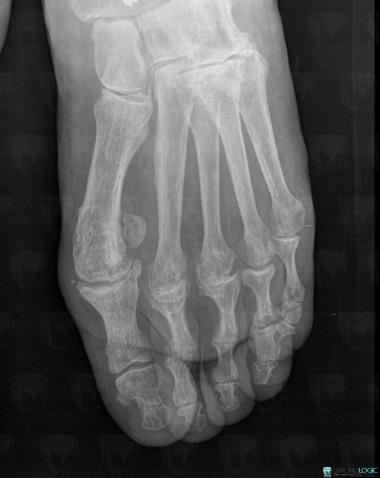 Radiology case : Rheumatoid arthritis (X rays) - Diagnologic