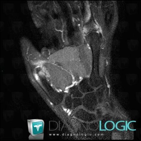 Rheumatoid arthritis, Metacarpophalangeal joints, MRI