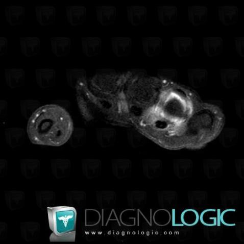 Rheumatoid arthritis, Metacarpophalangeal joints, MRI