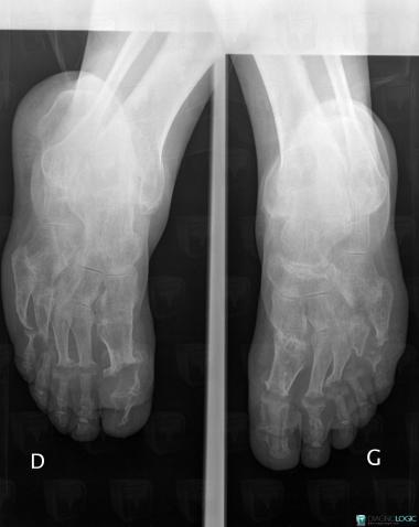 Rheumatoid arthritis, Metacarpophalangeal joints, Phalanx / Sesamoid bones - Foot, X rays