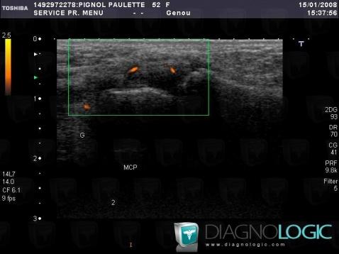 Rheumatoid arthritis, Metacarpophalangeal joints, US