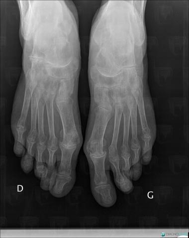 Rheumatoid arthritis, Metacarpophalangeal joints, X rays