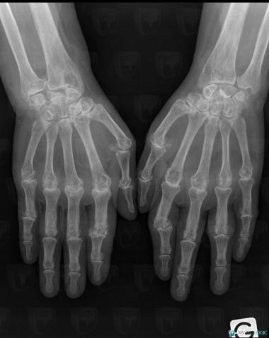Rheumatoid arthritis, Radius - Distal part, Mediocarpal joint, X rays