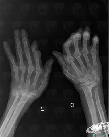 Rheumatoid arthritis, Radius - Distal part, Ulna - Distal part, X rays