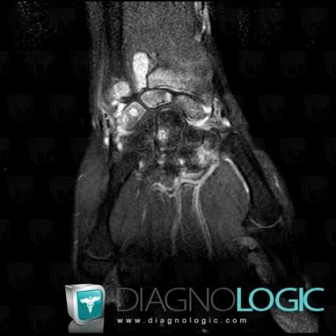 Rheumatoid arthritis, Scaphoid, Lunate, MRI