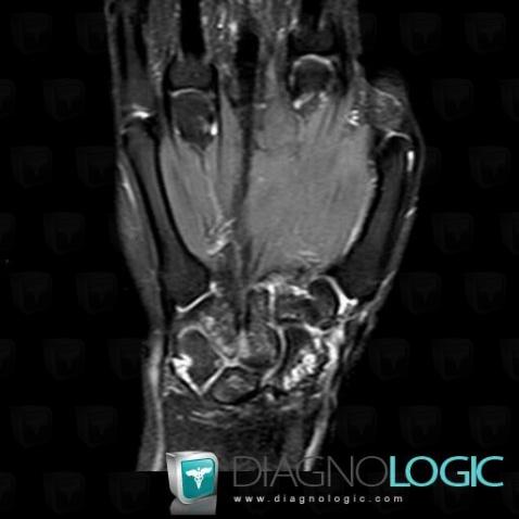 Rheumatoid arthritis, Scaphoid, MRI