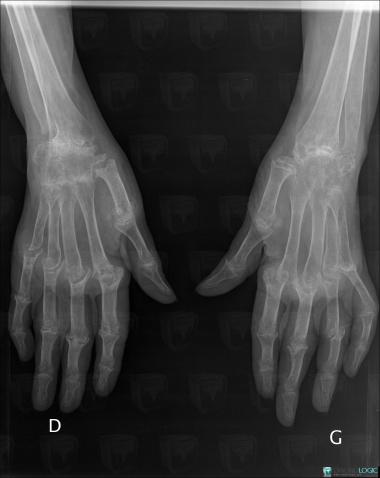 Rheumatoid arthritis, Ulna - Distal part, Mediocarpal joint, X rays