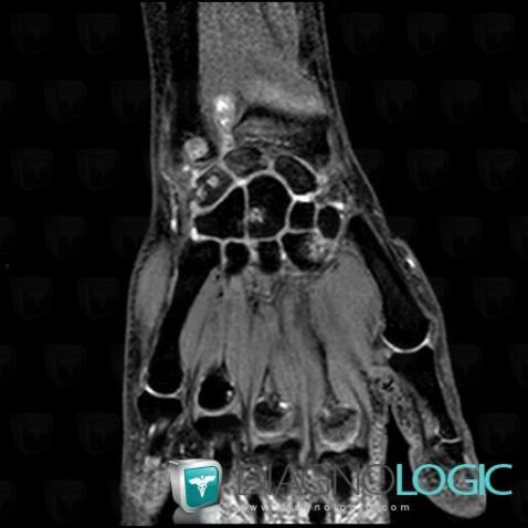 Rheumatoid arthritis, Ulna - Distal part, Other carpal bones, MRI