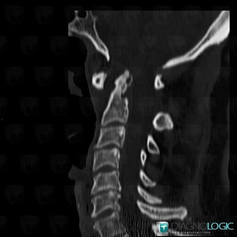 Rheumatoid arthritis, Vertebral body / Disk, CT