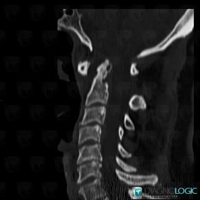 Rheumatoid arthritis, Vertebral body / Disk, CT