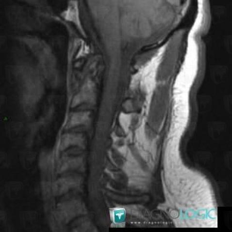 Rheumatoid arthritis, Vertebral body / Disk, MRI