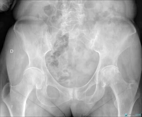 Rhumatisme psoriasique, Articulation sacro iliaque, Radio