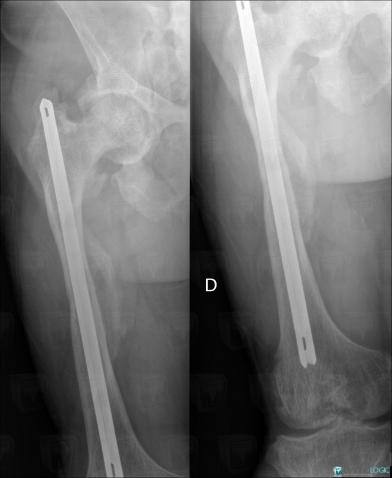 Rickets, Femur - Mid part, X rays