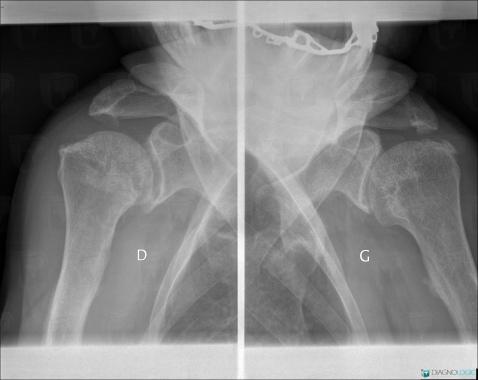 Rickets, Femur - Proximal part, Femur - Proximal part, Theoretical