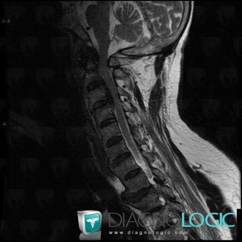 Rickets, Vertebral body / Disk, MRI