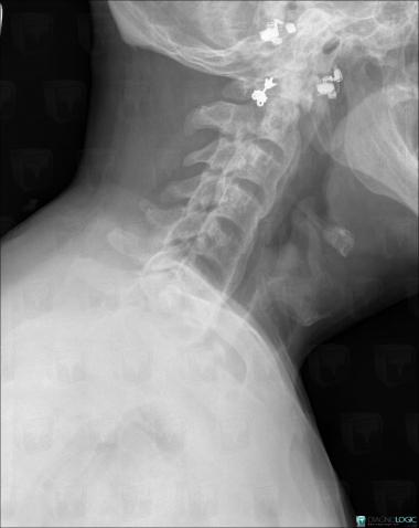 Rickets, Vertebral body / Disk, X rays