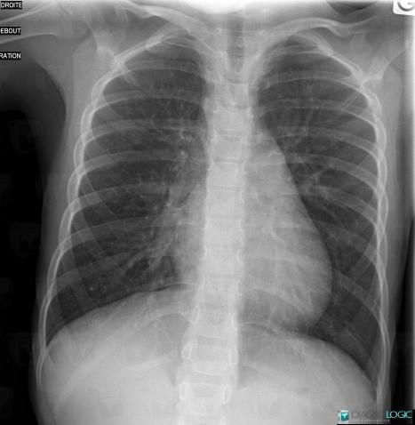 Right aortic arch, Aorta, X rays