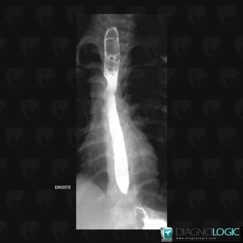 Right aortic arch, Oesophagus, X rays