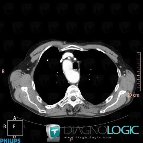 Right aortic arch with mirror branching, Aorta, CT