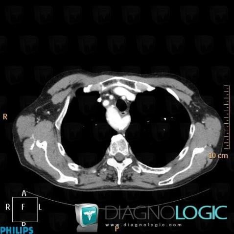 Right aortic arch with mirror branching, Supra aortic vessels, CT