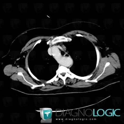 Right posterior aortic arch with aberrant left subclavian artery, Aorta, CT