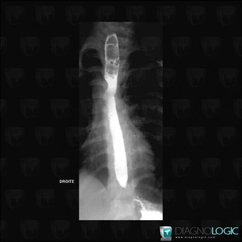 Right posterior aortic arch with aberrant left subclavian artery, Aorta, Oesophagus, X rays