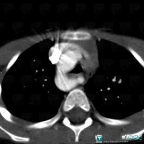 Right posterior aortic arch with aberrant left subclavian artery, Aorta, Supra aortic vessels, CT