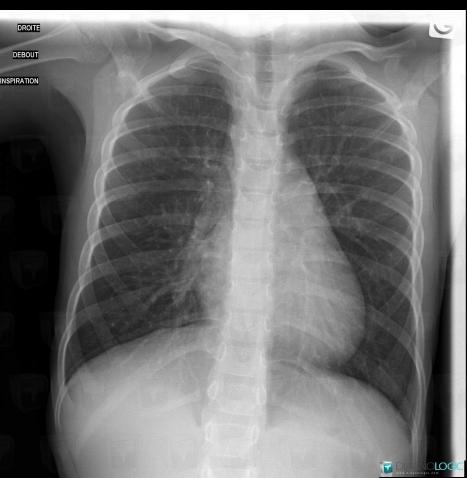 Right posterior aortic arch with aberrant left subclavian artery, Aorta, X rays