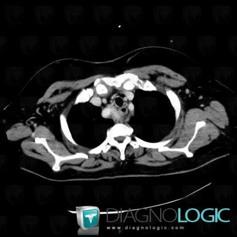 Right posterior aortic arch with aberrant left subclavian artery, Supra aortic vessels, CT