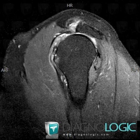 Rotator cuff tears, Infraspinatus tendon, MRI
