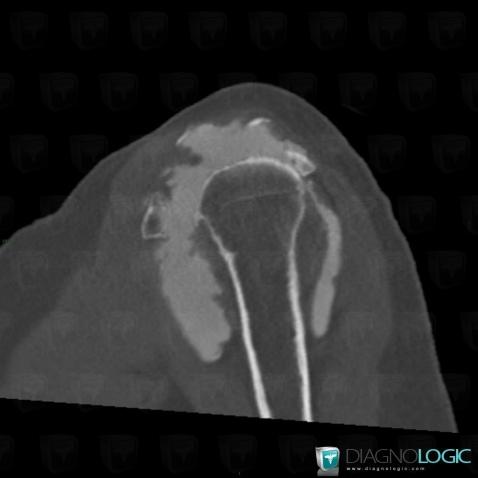 Rotator cuff tears, Sub scapularis tendon, CT