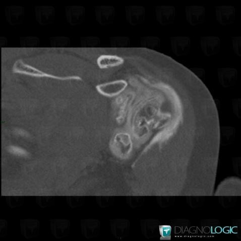 Rotator cuff tears, Supraspinatus tendon, CT