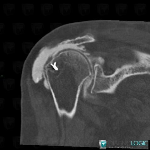 Rotator cuff tears, Supraspinatus tendon, CT