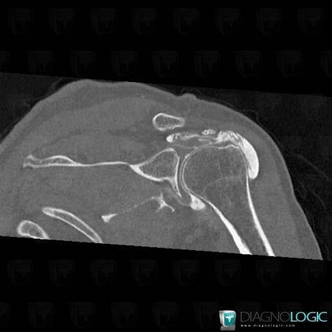 Rotator cuff tears, Supraspinatus tendon, CT