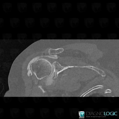 Rotator cuff tears, Supraspinatus tendon, CT