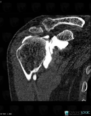 Rotator cuff tears, Supraspinatus tendon, CT