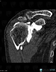 Rotator cuff tears, Supraspinatus tendon, CT