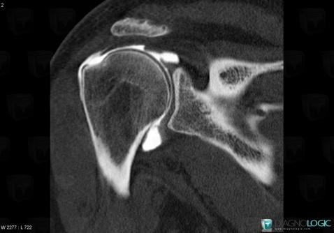 Rotator cuff tears, Supraspinatus tendon, CT