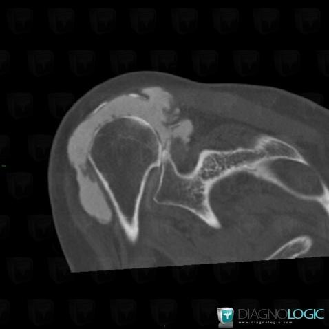 Rotator cuff tears, Supraspinatus tendon, CT